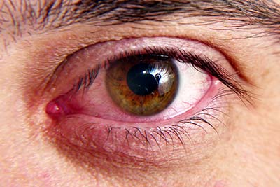 dry-eye
